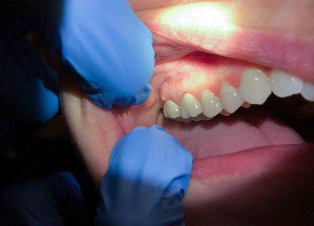 Best Emergency Care for Gum Disease in Indian Head, MD