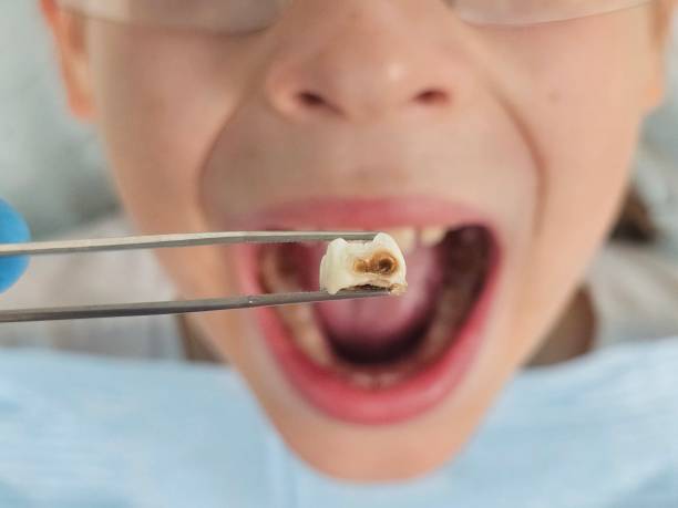 Best Knocked-Out Tooth (Avulsed Tooth) Treatment in Indian Head, MD